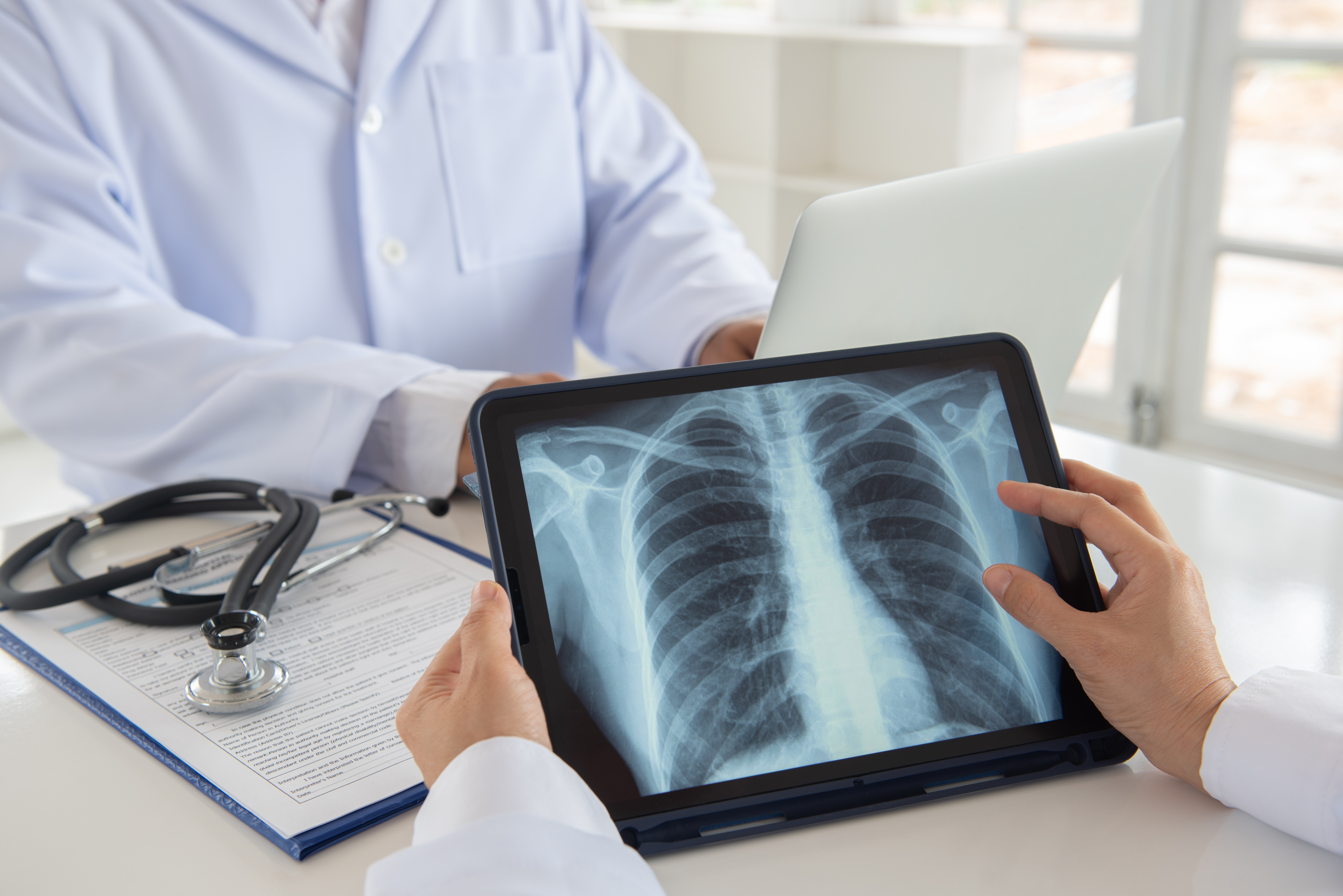 LungCancer Xray